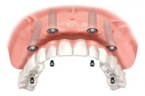 4 zubni implantaty
